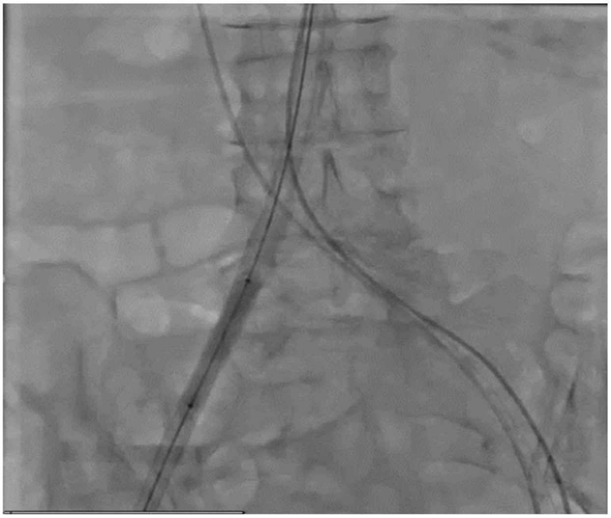 Endovascular eSheath Predilation to Facilitate Transfemoral